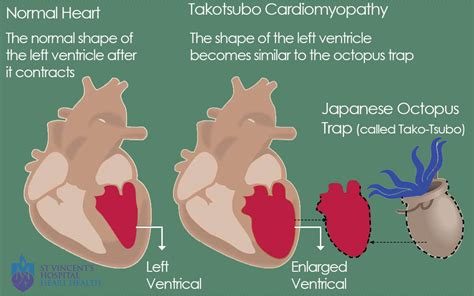 broken heart syndrome takotsubo